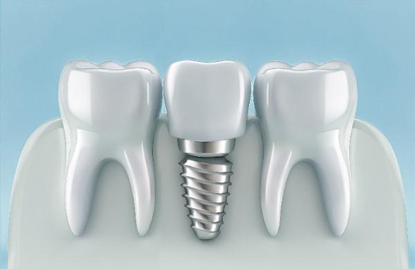 Dental Implants
