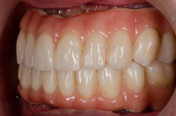 invisalign