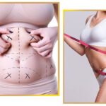 Liposuction in Islamabad