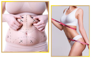 Liposuction in Islamabad