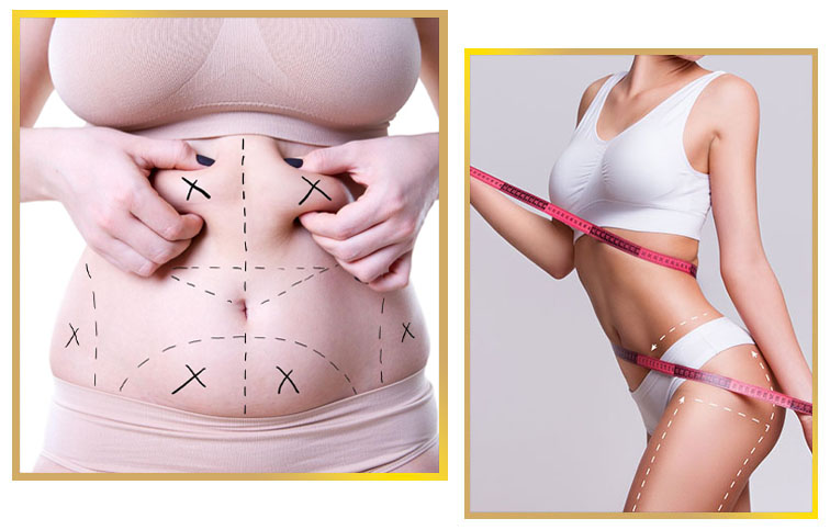Liposuction in Islamabad