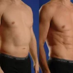 Male chest fat surgery in Islamabad