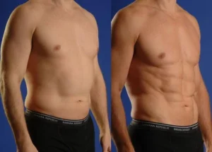 Male chest fat surgery in Islamabad