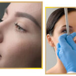 Rhinoplastic surgery Islamabad