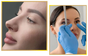 Rhinoplastic surgery Islamabad