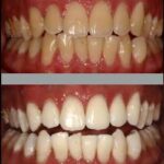whitening_compare_1