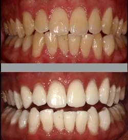 whitening_compare_1