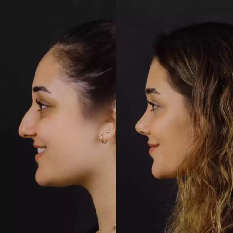 septoplasty in dubai