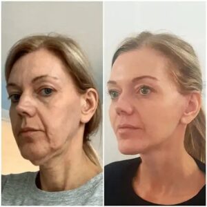 Profhilo treatment in dubai
