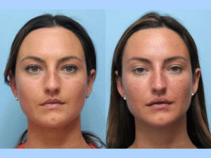 PDO Perfection at the Best Aesthetic Clinics in Dubai for Thread Lift