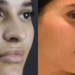 rhinoplasty in dubai
